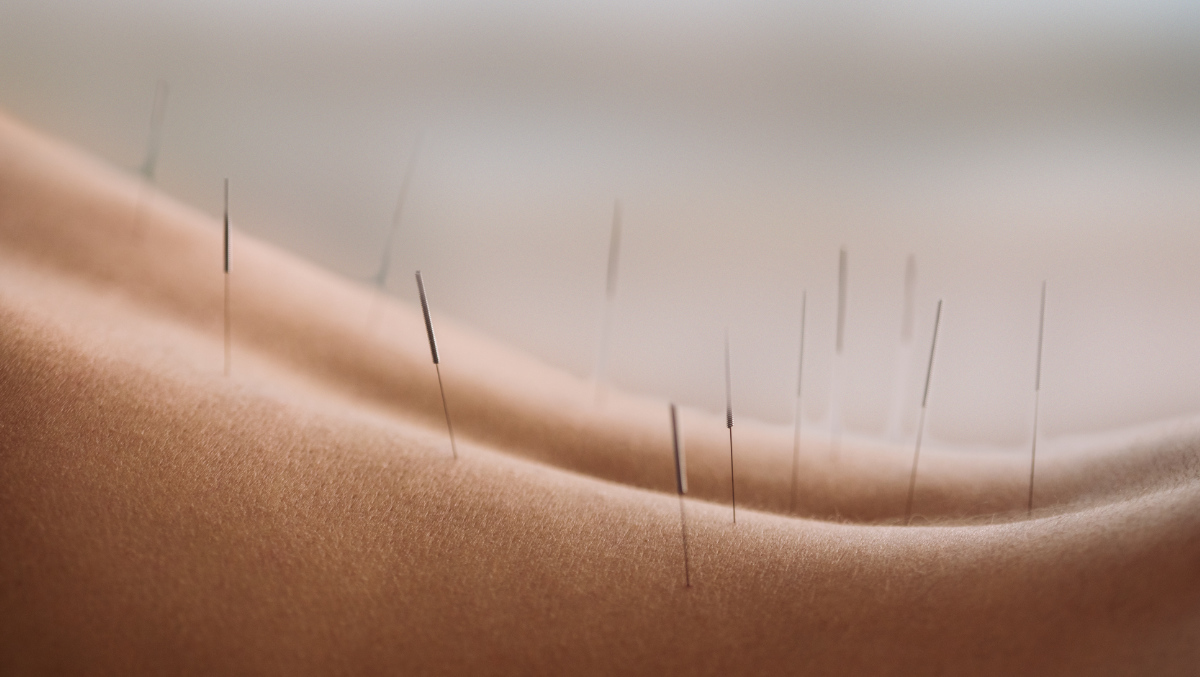 Akupunktur bei Rückenschmerzen